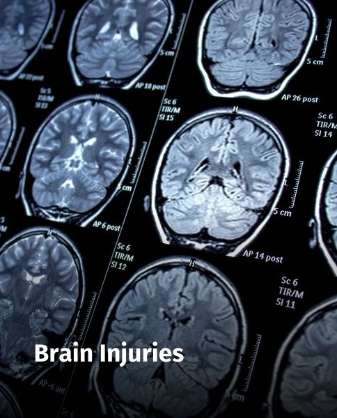 Brain Injuries