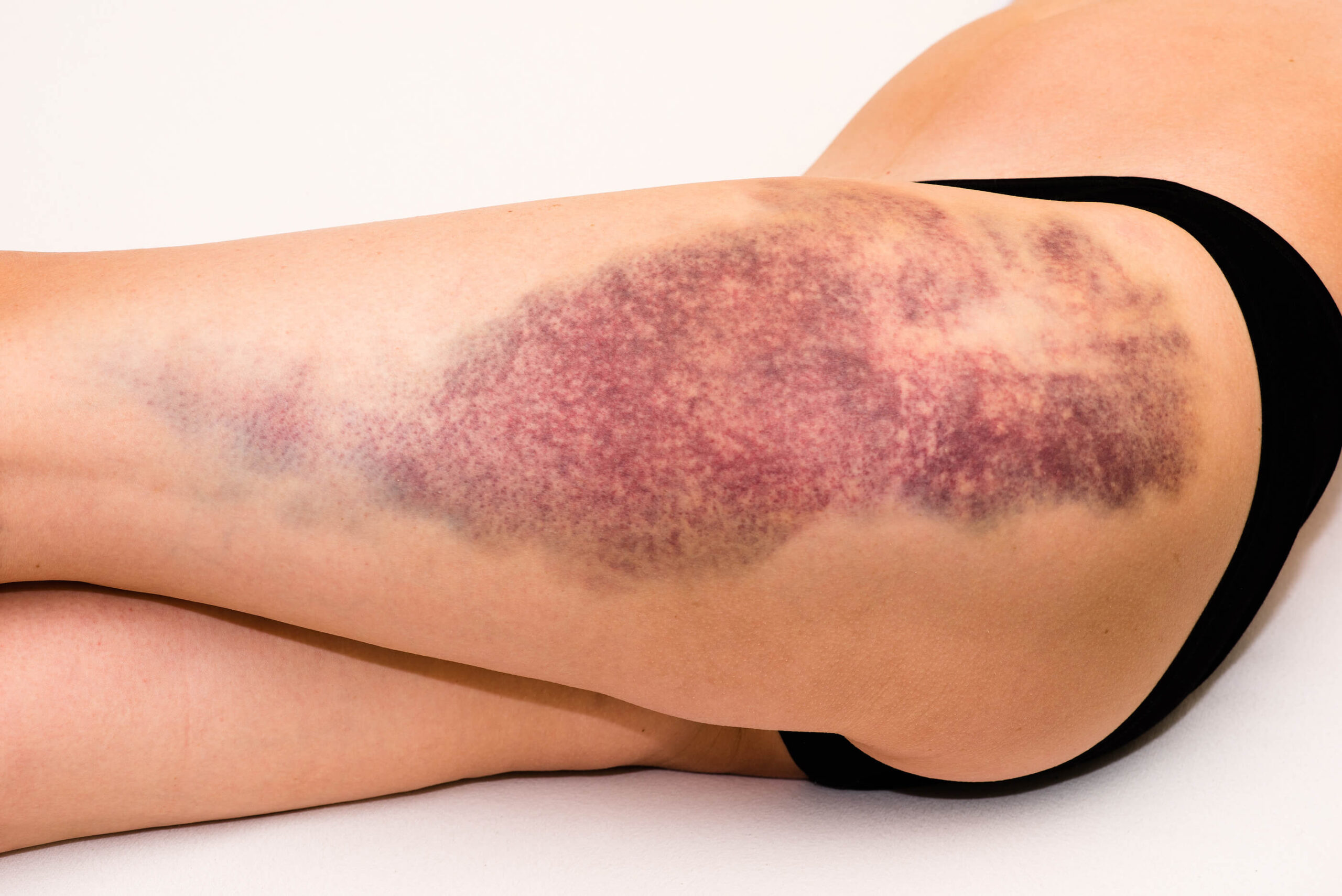 652486043-lacerations-and-contusions